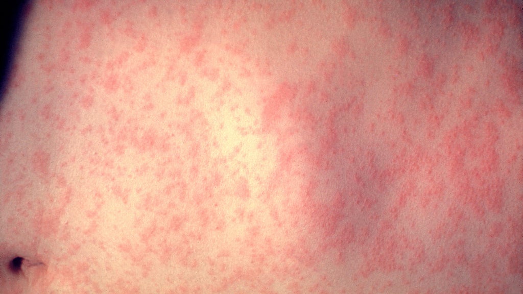 25 cases of measles identified in central, southeastern Minnesota, MDH says — WCCO / CBS Minnesota, Edina Health news